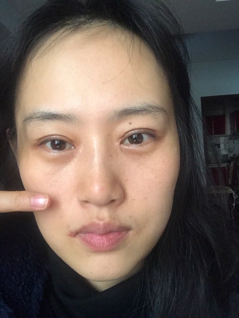 没有眼窝凹陷好了吗