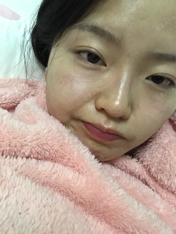 Rylynn面部吸脂第102天美丽日记-新氧美容整形