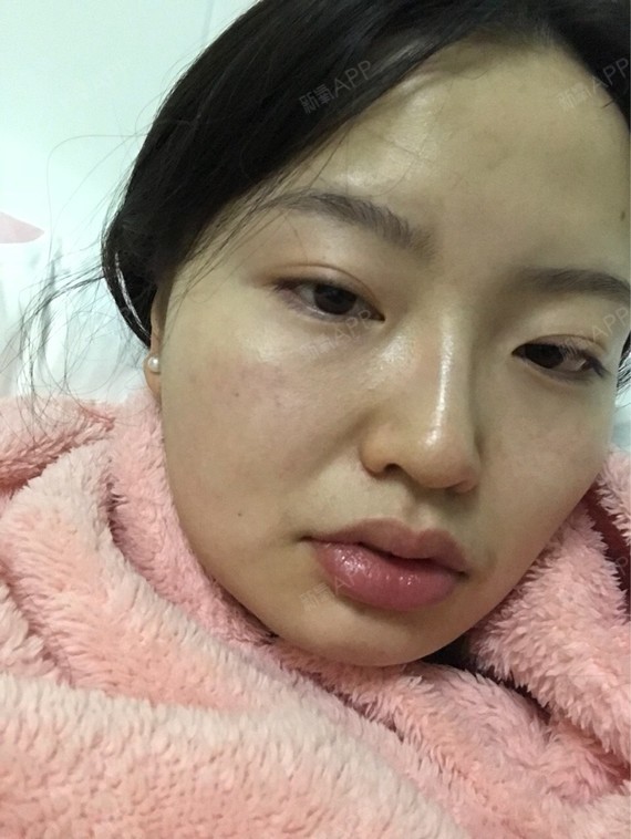 Rylynn面部吸脂第102天美丽日记-新氧美容整形