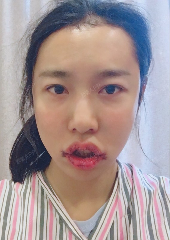 m唇手术