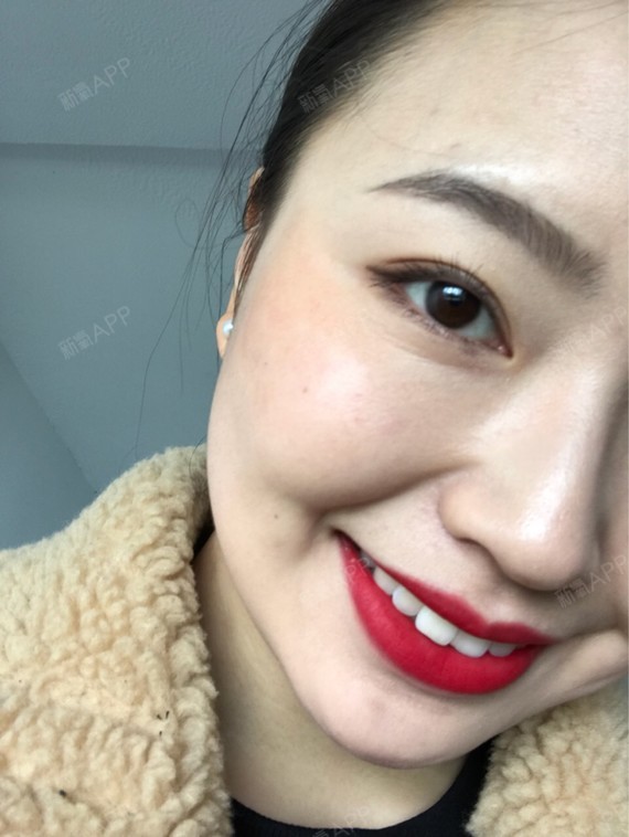 Rylynn面部吸脂第109天美丽日记-新氧美容整形