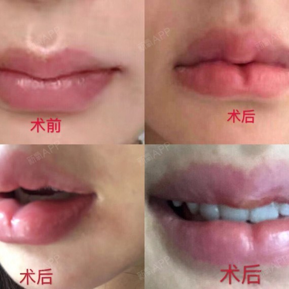 唇部 | 术后当自强 | 北京同城 | 上海同城 | m唇手术 | 微笑唇/m唇