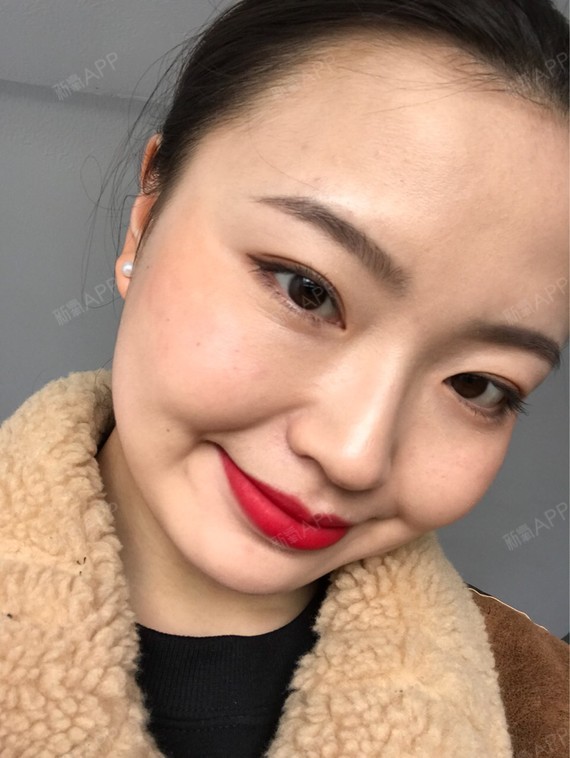 Rylynn面部吸脂第109天美丽日记-新氧美容整形