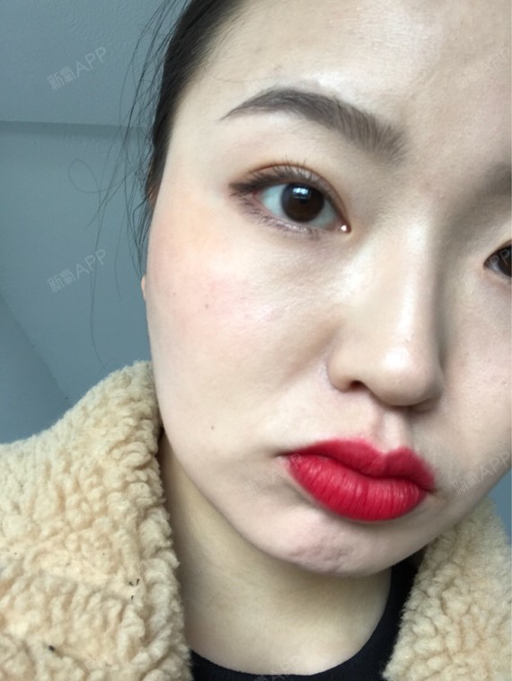 Rylynn面部吸脂第109天美丽日记-新氧美容整形