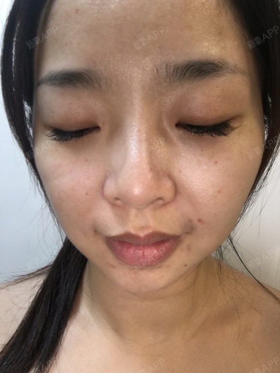 坚持了5天,终于不是麻子妹了,肌肤变得比较有光泽