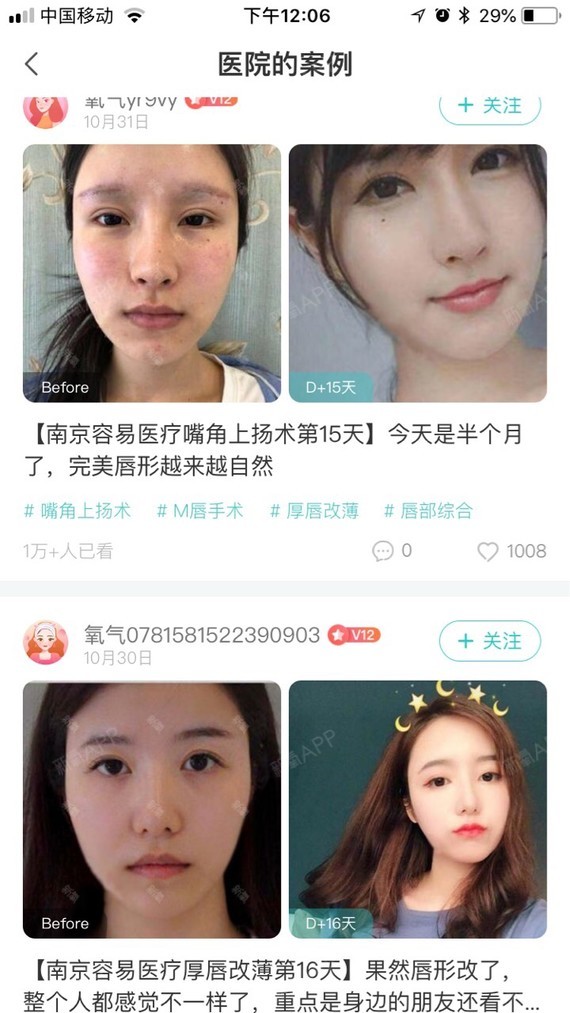 m唇手术