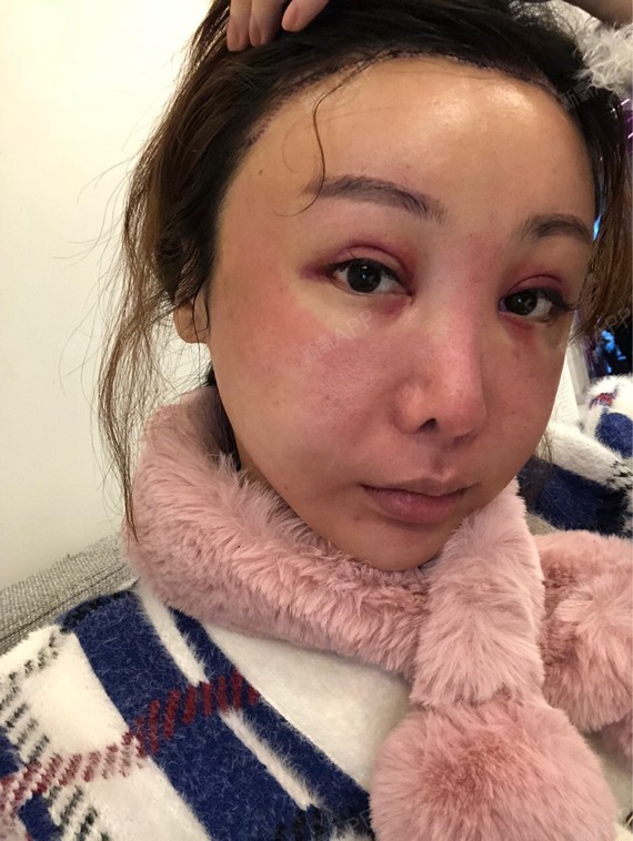 术后第二天:我去做了一个飞梭激光,脸红红的,好可怕