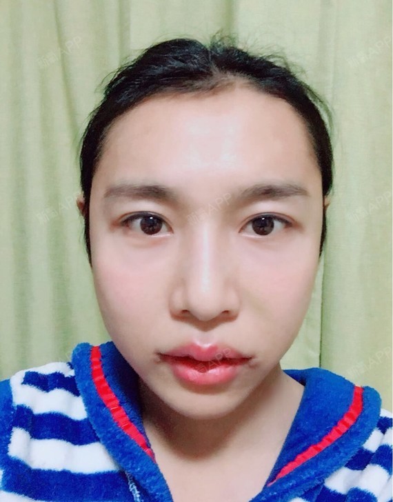m唇手术