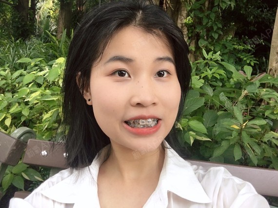 嘻嘻嘻 已经是矫正的第105天啦 其实已经完全适应这个小钢牙了~ 仿佛