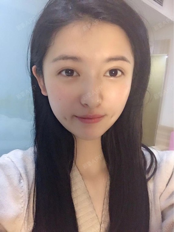 氧气i1m7a42酒窝成形术术后第1天美丽日记_新氧整形