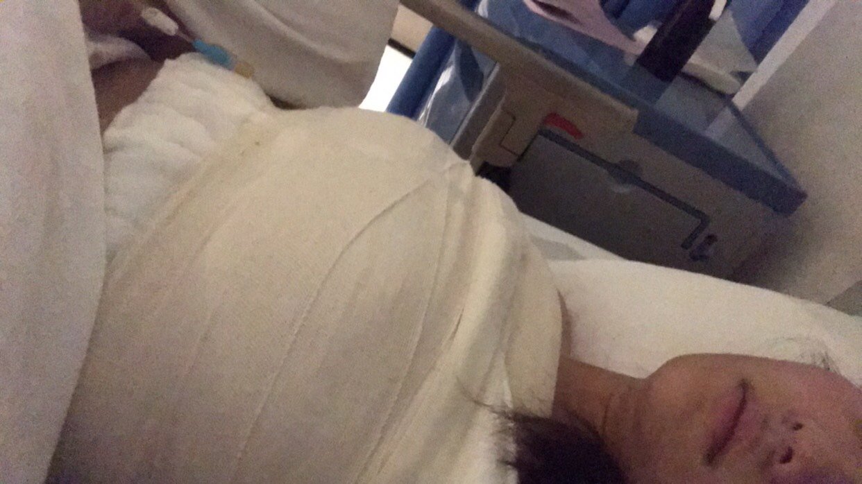 假体隆胸第2天