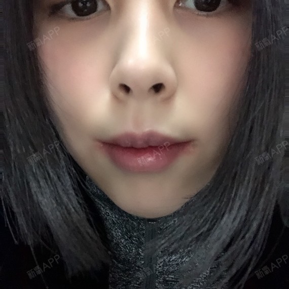 m唇手术