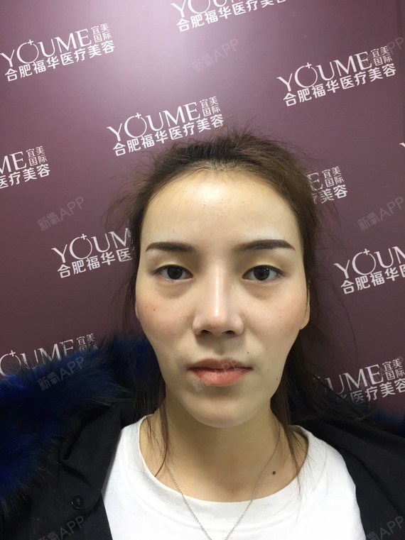 自体脂肪面部填充