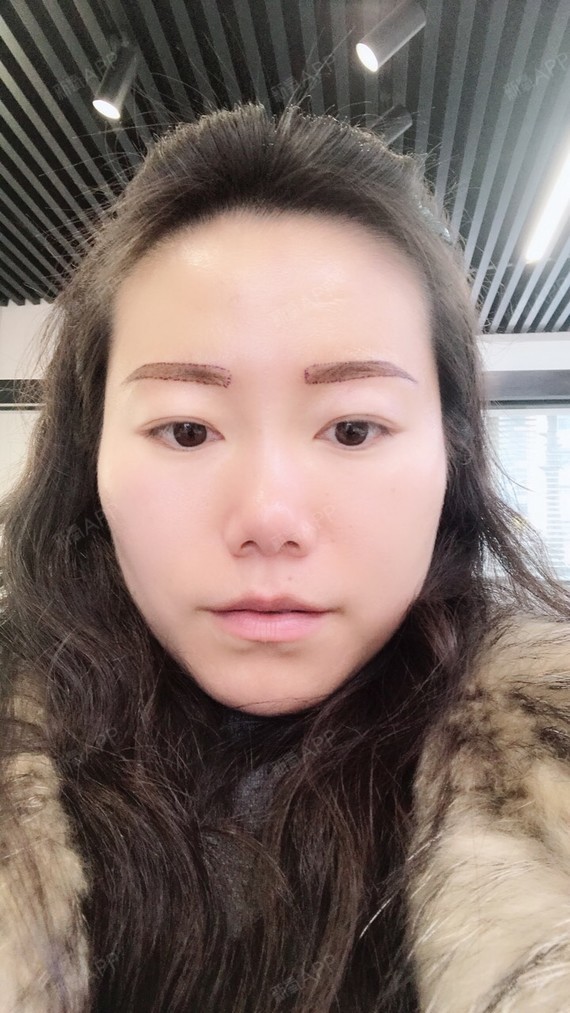 成都种植眉毛好不好_效果图_氧气xt774d5种植眉毛术后第0天_新氧美容