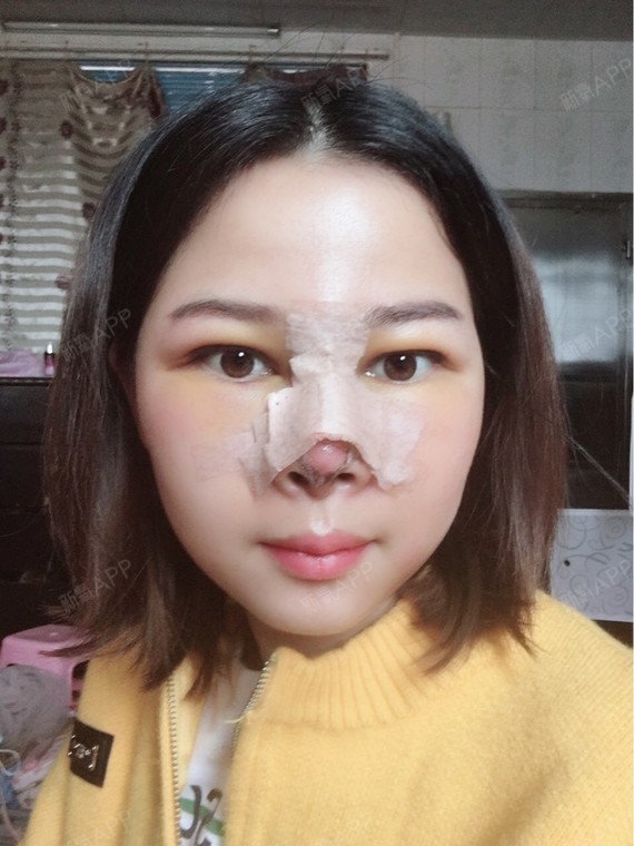 第五天了还有点肿,鼻子里面还有小黄水流出来,不知道是不是产生了排异