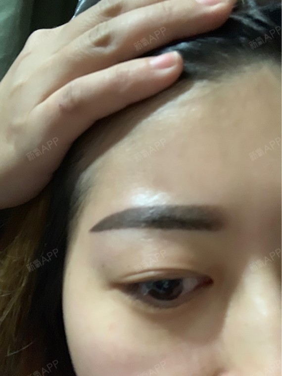 红肿不明显偶尔有点痒