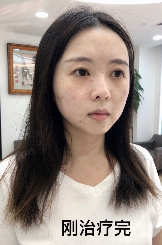 【深圳和美91超皮秒12天】颤抖吧,我的痘印和小晒斑_圈子-新氧美容