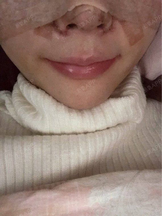 m唇手术