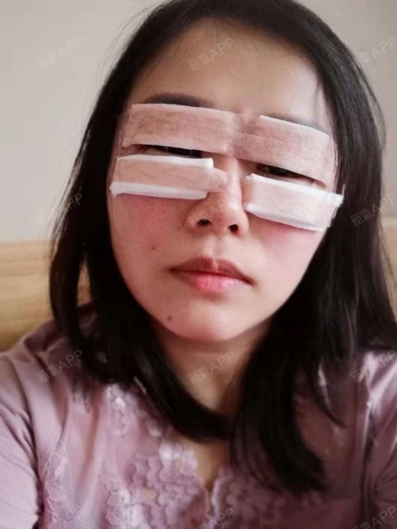 期待拆纱布.