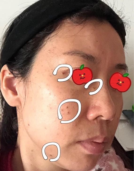 激光点痣