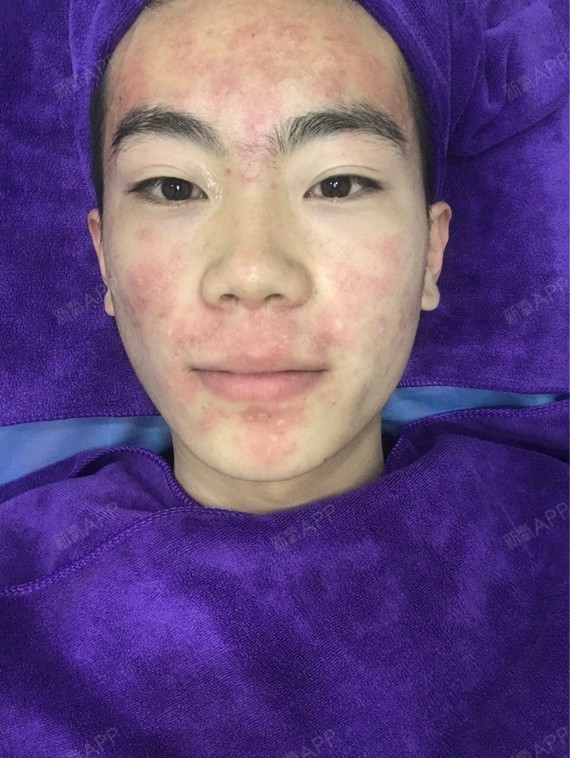通过新氧消费方案查看果酸焕肤其他轻度疼痛收缩毛孔