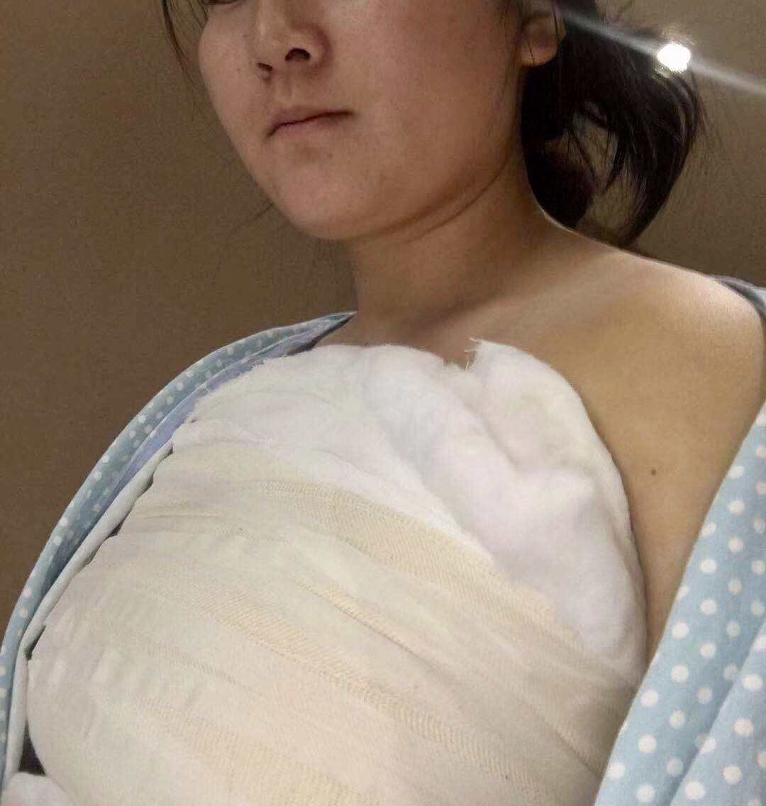 我是利利,从小就是胸都不大,但是副乳很严重,生完宝宝以后,乳房严重