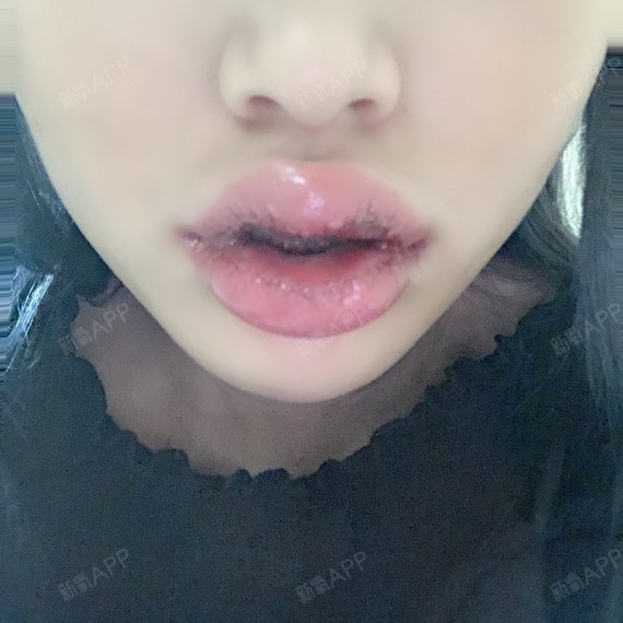 m唇手术