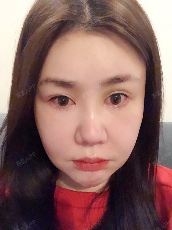 下眼下至术