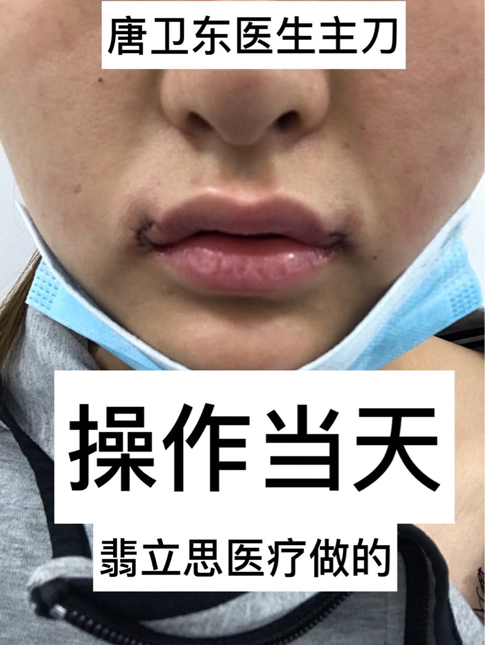 嘴角上扬术第115天