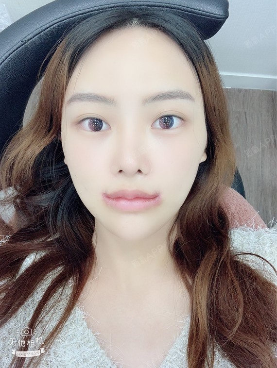 新氧- tiffany佳霓儿 | 面部轮廓 | 术后当自强 | 埋线提升 | 北京