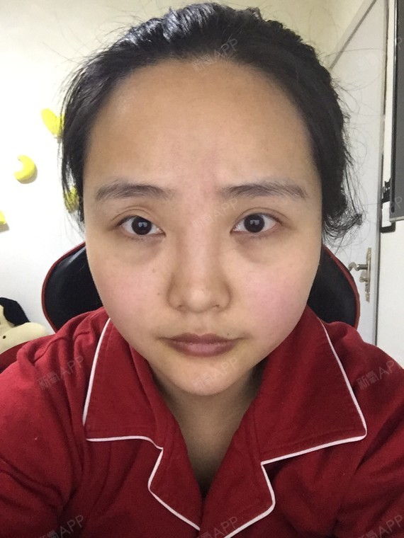 所以想真正的去眼袋,黑眼圈,只能去医院做手术,才有用,眼霜的作用并不