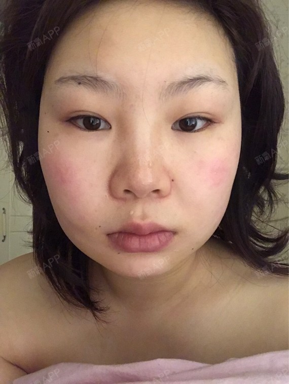 但是我发现我的右边脸大_圈子-新氧美容整形