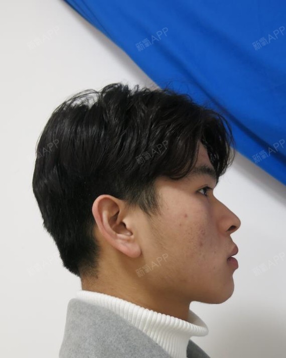 我的咬肌比较发达,挺想打瘦脸针,而且现在男生打瘦脸