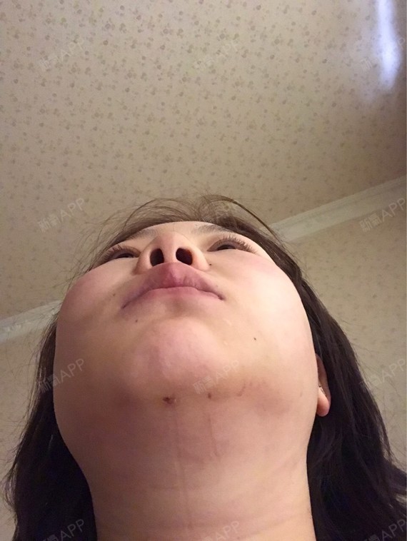 但是我发现我的右边脸大了太多了,好明显的大了.是因为抽的不一样吗?