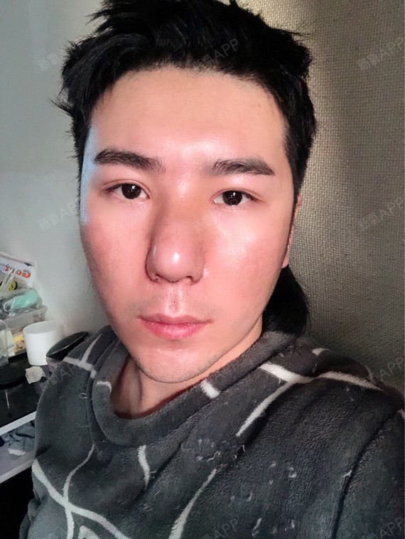 手术缩鼻头