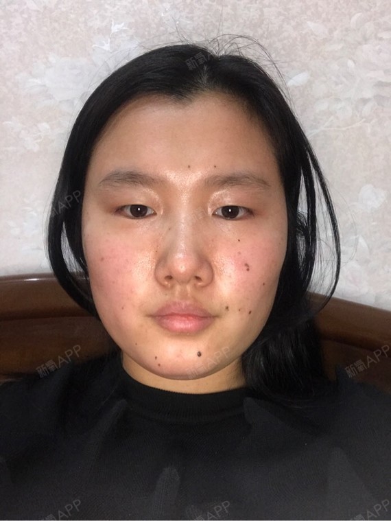 我认为我的右脸现在比左脸宽,没事真不要瞎整,这两天我一直在
