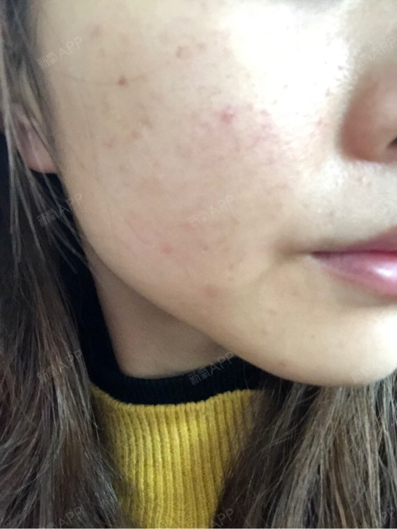没有任何起色,皮肤还是一如既往的爱出油,暗黄,还长了好多痘痘