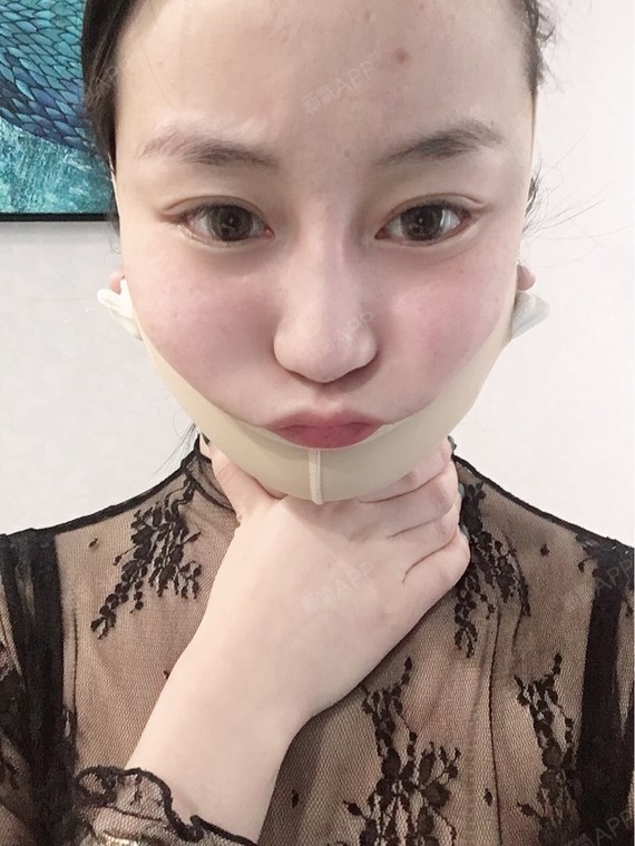 刚做完面部吸脂,实在太搞笑了,忍不住想拍照～哈哈哈