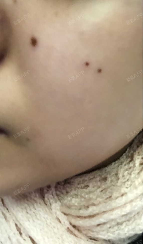 新氧- 不可以吃兔兔 | 皮肤 | 术后当自强 | 激光点痣 | 南宁同城