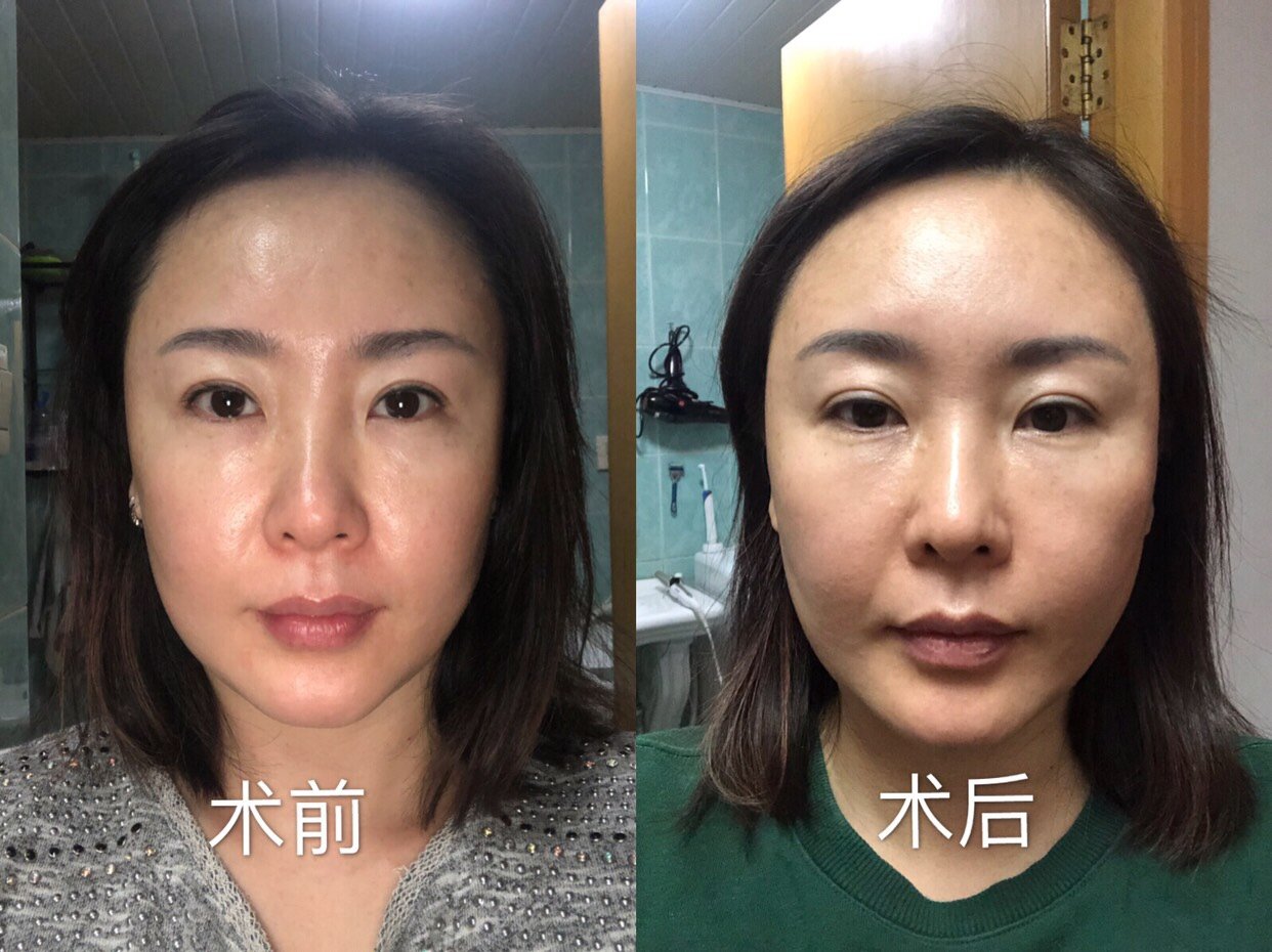 水光针第41天