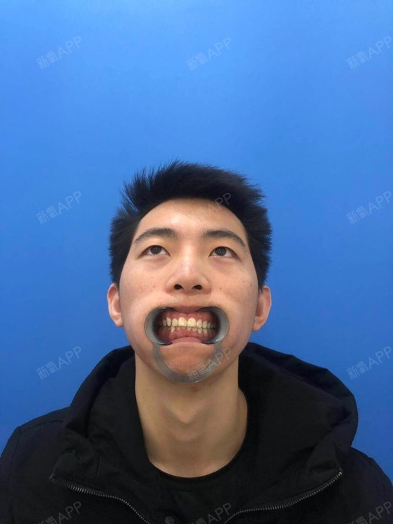上下颚手术/突嘴矫正