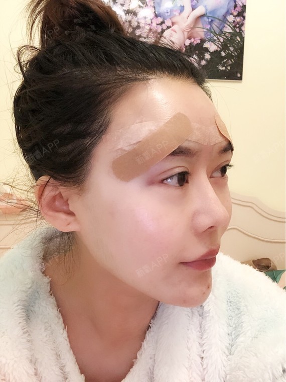 假体垫眉弓