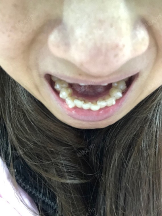 第六幅牙套了……9596上牙还是乱七八糟的00在