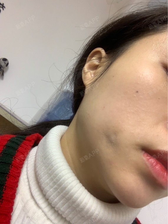 10月去做的第一次手术,右边酒窝四天后消失,然后开