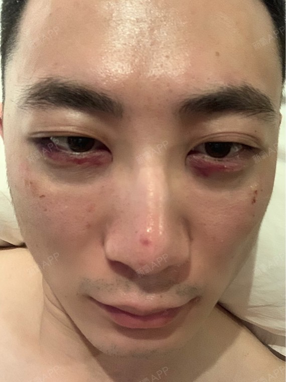 激光去眼袋