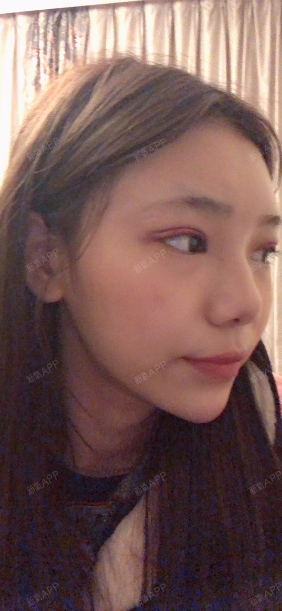 温州埋线双眼皮好不好_效果图_氧气qyyba4a埋线双眼皮