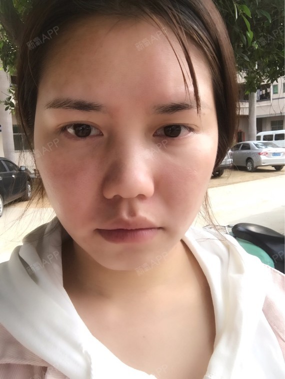 本人是标准的屁股下巴又称美人沟,但我真不觉得美,下_圈子-新氧美容