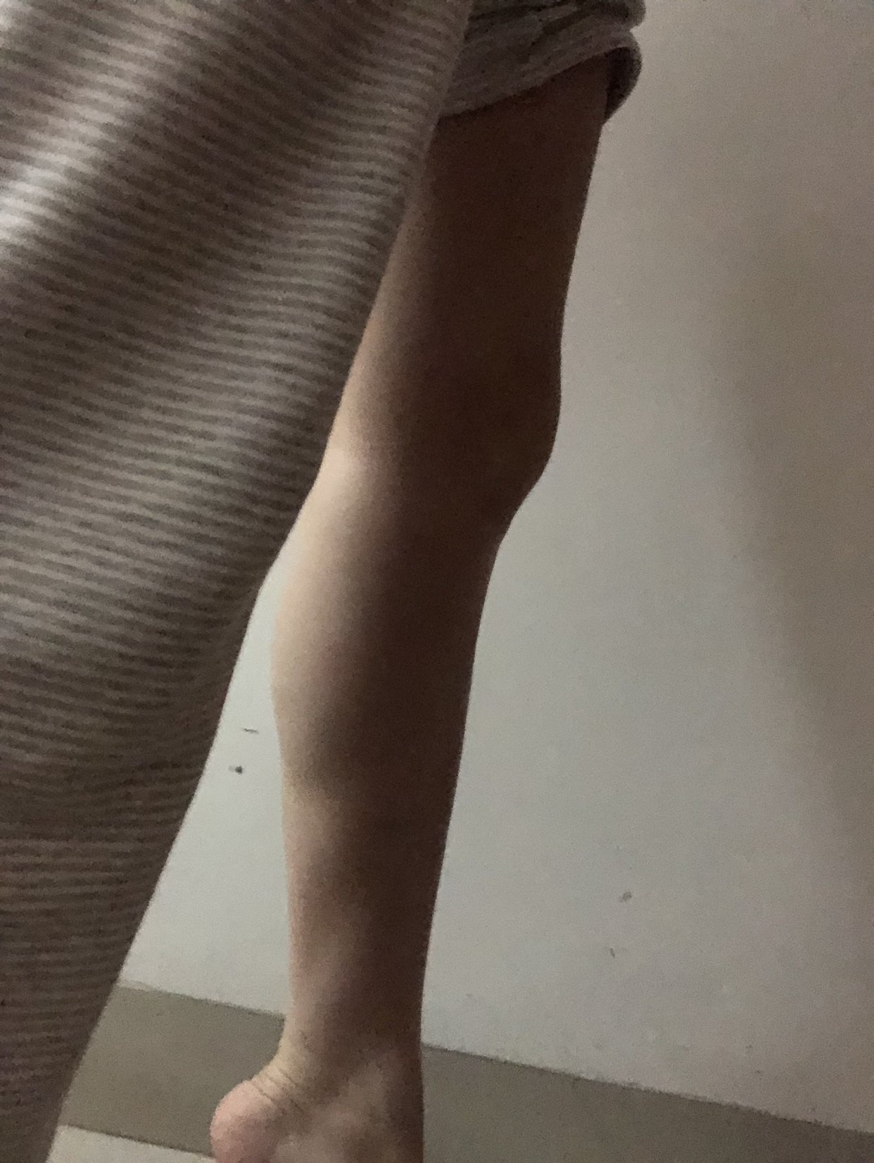 想变美的鱼的美丽日记"2.20"肉毒素瘦小腿