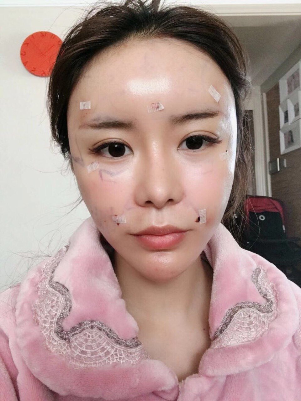 自体脂肪全脸填充第4天