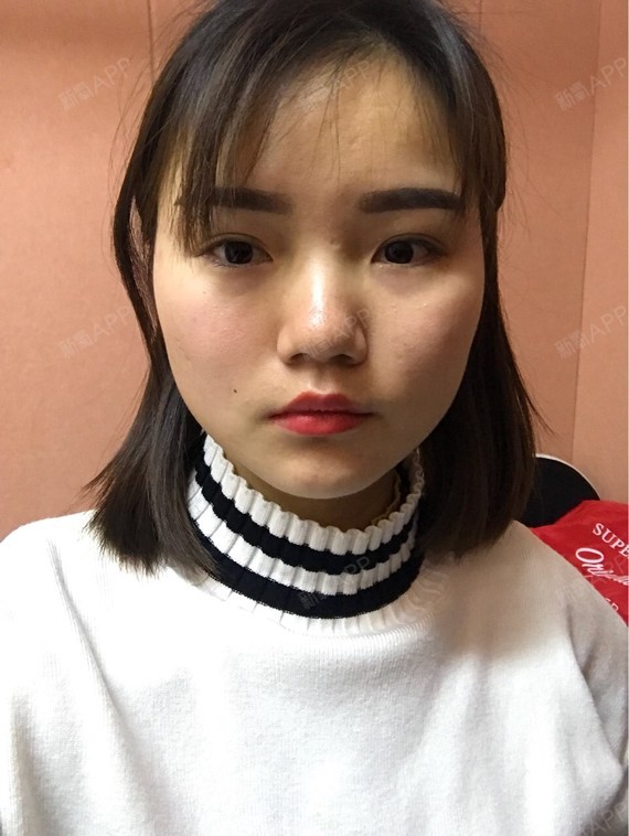 独木桥71肉屁股瘦脸第6天美丽日记腿和毒素瘦是怎么回事图片